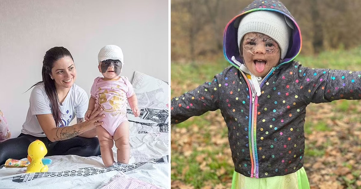 q4 6.jpg?resize=1200,630 - "Look At Me, My Black Spot Is Gone"- 2-Year-Old Girl Born With 'Batman Mask' Birthmark CRIES Tears Of Joy After Successful Surgery