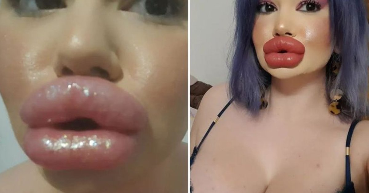 q7 1 1.jpg?resize=1200,630 - Woman With 'World's Biggest Lips' Gears Up To Get A BIGGER POUT For Christmas