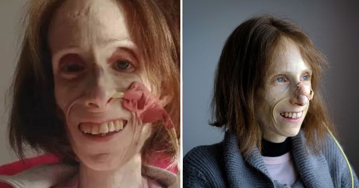 d122 1.jpg?fit=1024%2C538&ssl=1&strip=all - "The Pain Is Unimaginable"- 37-Year-Old Woman Weighing Just '42 Pounds' Sheds Light On Her Agonizing Health Condition