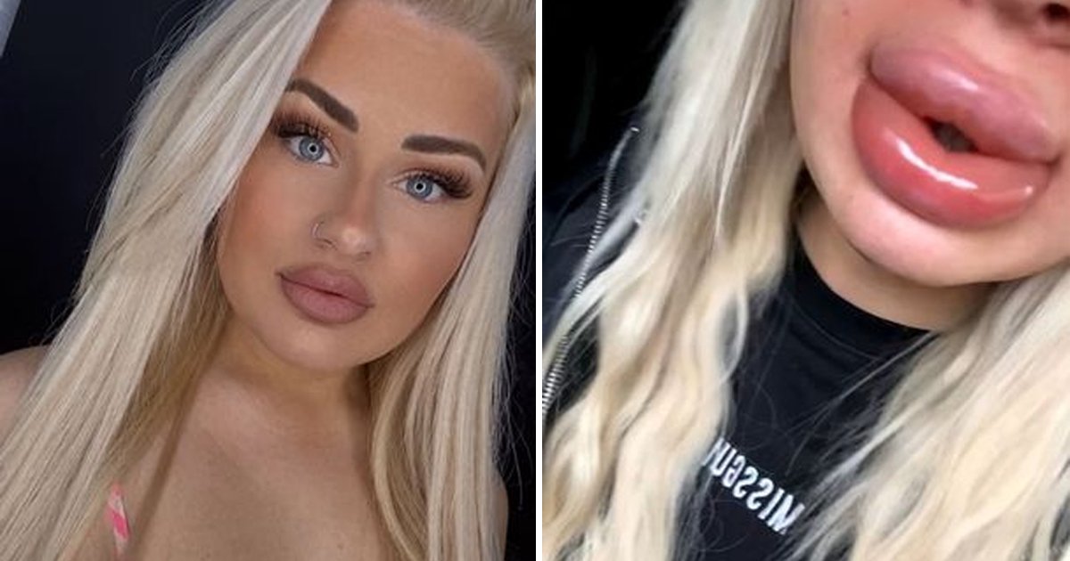 d33.jpg?resize=412,275 - Beauty Fanatic Horrified After Being Left With Giant 'Sausage Lips' That Were 20 TIMES Larger