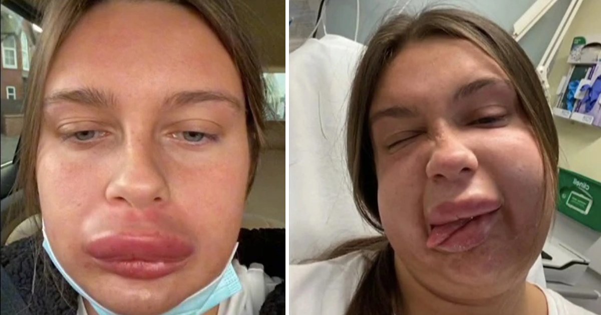 q3 8.jpg?resize=1200,630 - Woman HOSPITALIZED & Left Looking Like 'Homer Simpson' After Getting Lip Filler Dissolved
