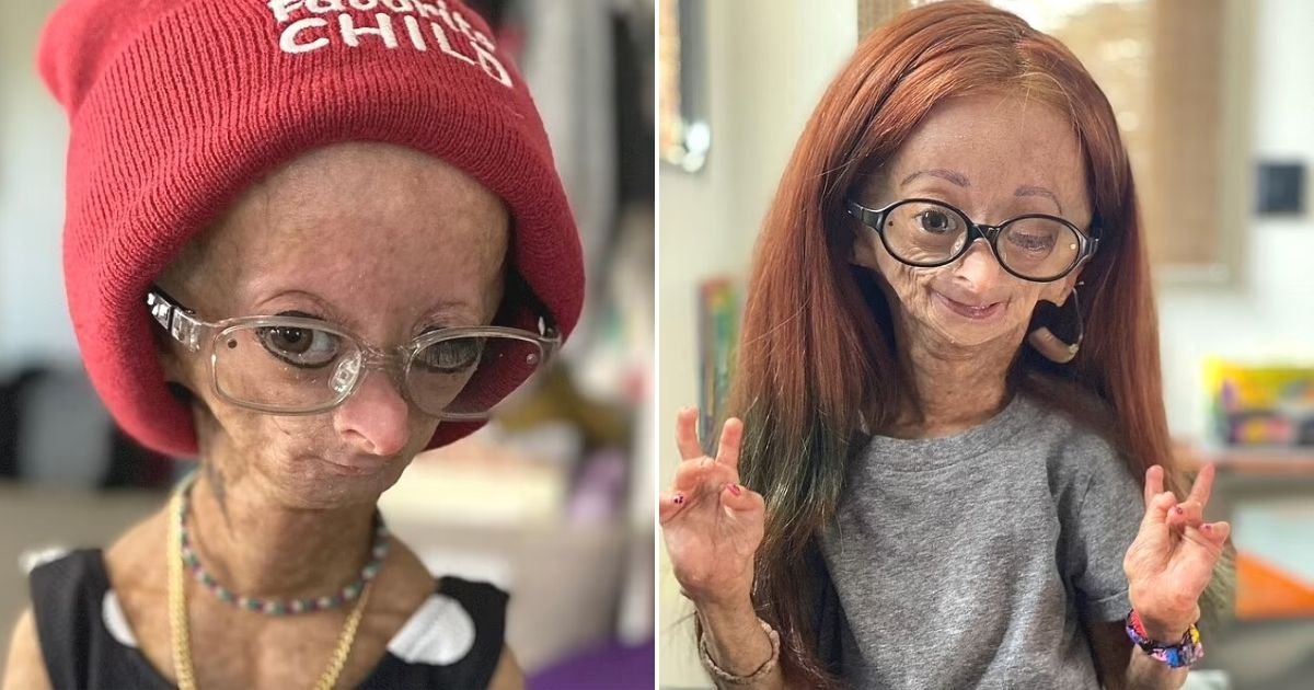 untitled design 6.jpg?fit=1024%2C538&ssl=1&strip=all - Girl Who Inspired Millions While Living With Real-Life Benjamin Button Disease Dies At The Age Of 15