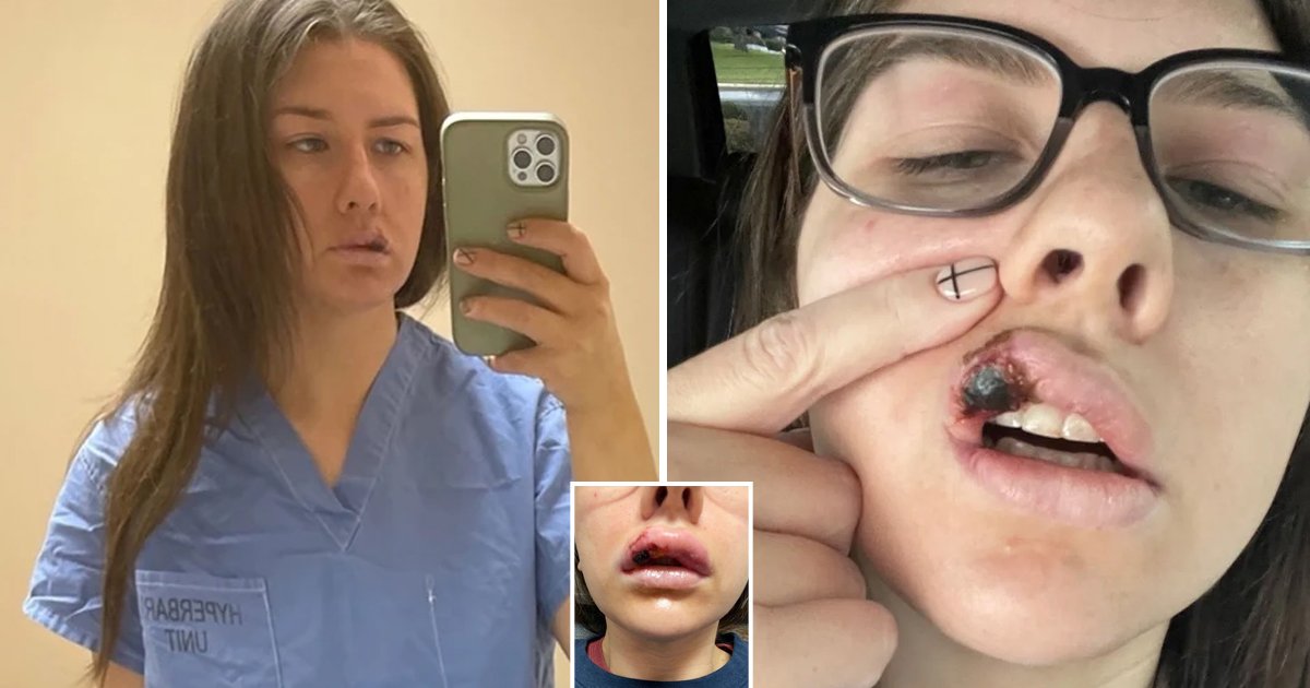 d144.jpg?resize=1200,630 - "I Almost LOST My Face!"- Nurse Recalls Nightmare Experience As Lip 'Began To Die' After A Botched Cosmetic Procedure