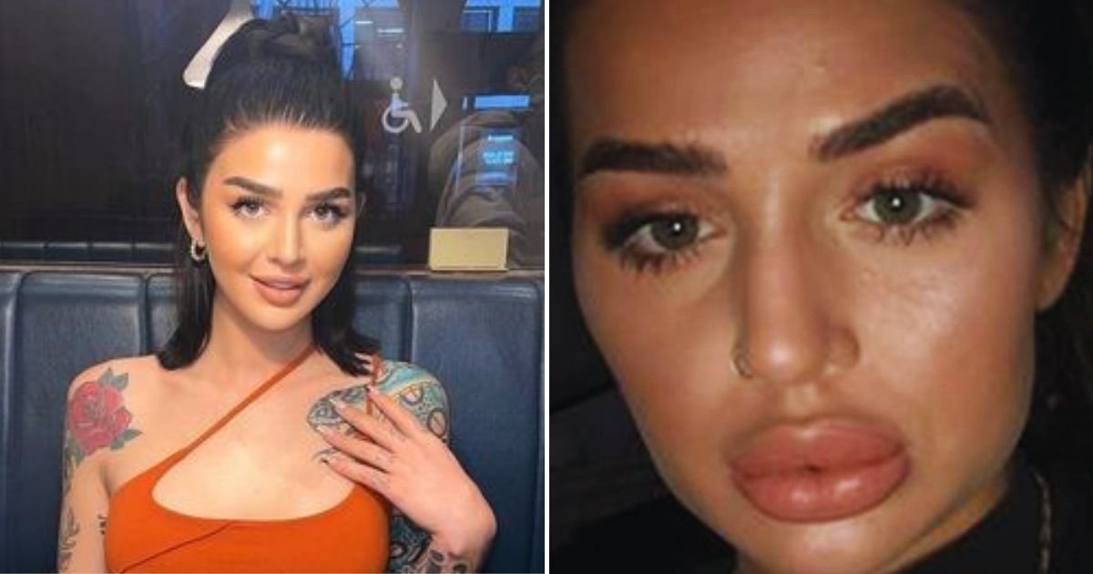 fillers.jpg?resize=412,232 - 27-Year-Old Woman Had Too Much Fillers It Left Her Face 'Deformed' After She Became Obsessed With Injections From Age Of 20