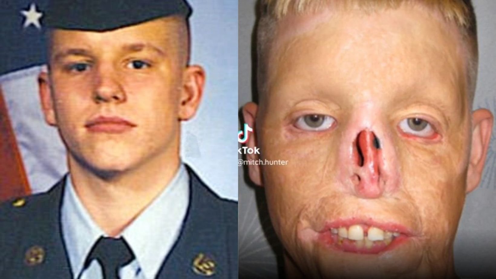 Ex Soldier Was Worlds Third Full Face Transplant Patient And Claims It Was The Best Decision Of 2187