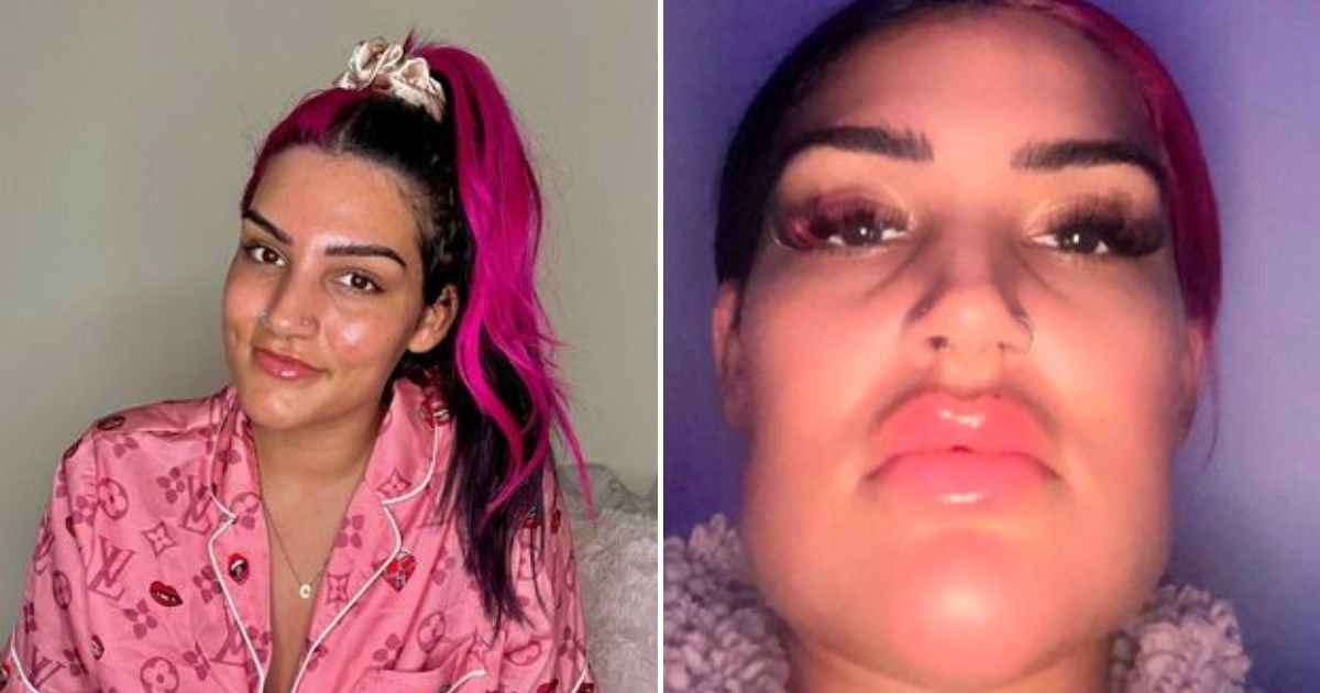 filler5.jpg?resize=412,232 - Woman Who Spent $780 On Lip Filler Was Left With A Swollen Chin, Leaving Her Looking Like Quagmire From Family Guy