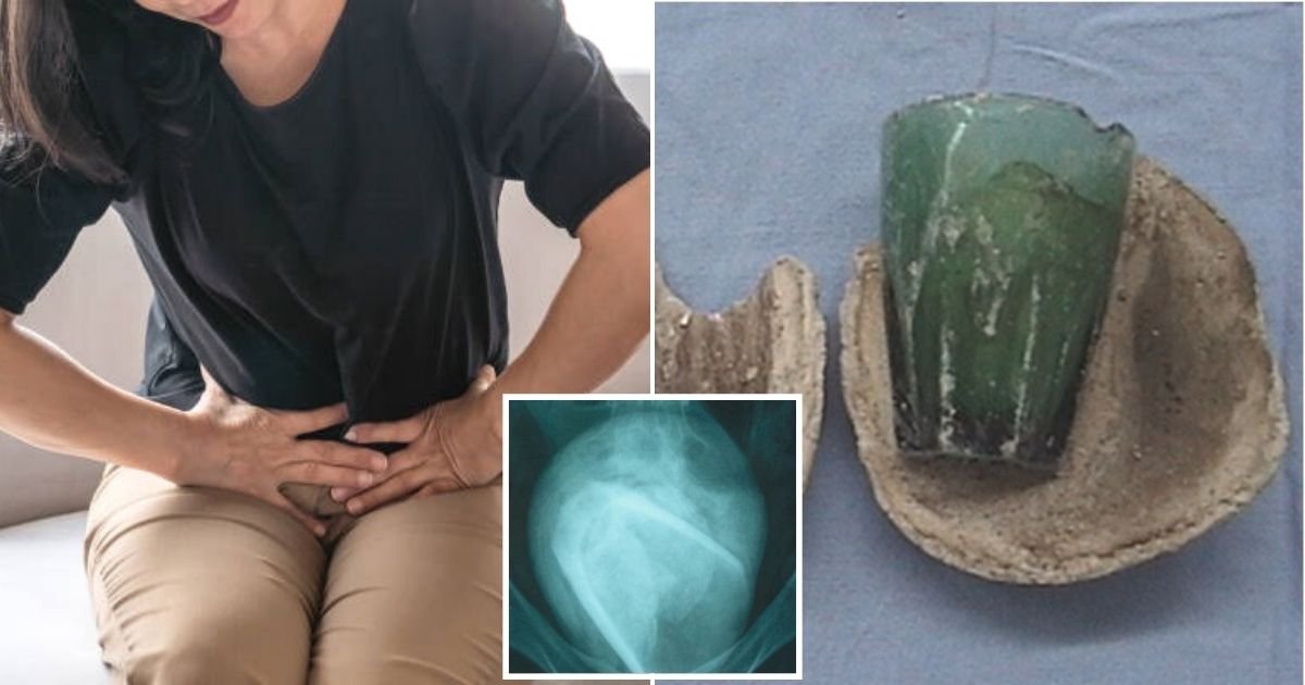 untitled design 43.jpg?fit=1024%2C538&ssl=1&strip=all - Doctors Discover A Glass TUMBLER Inside A Woman's Bladder After She Complained About UTI-Like Symptoms