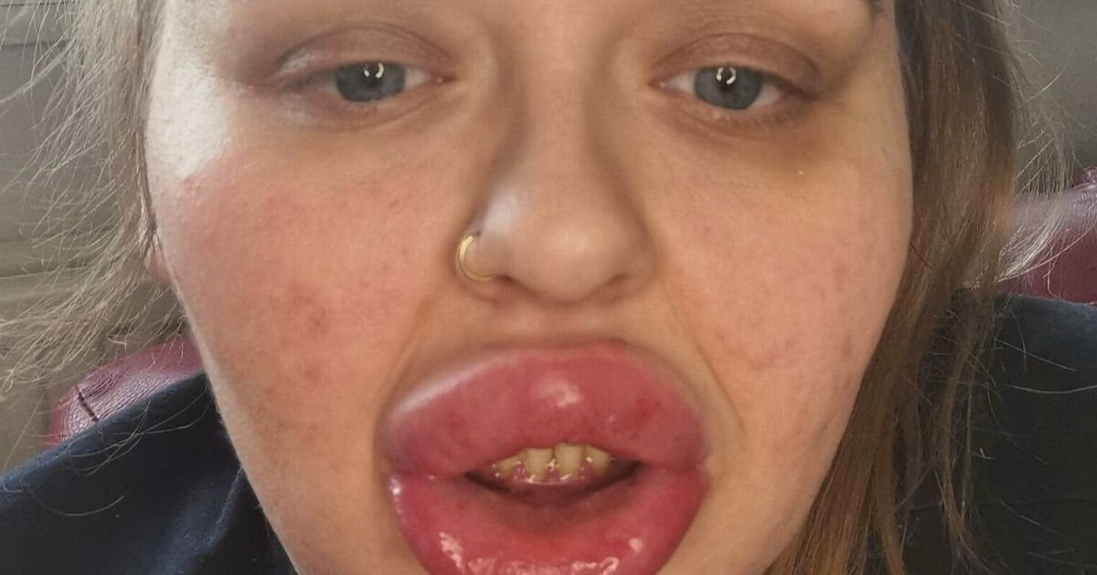 lips5.jpg?resize=412,275 - 29-Year-Old Mother Left Unable To Talk And Struggling To Breathe After Suffering An Allergic Reaction To Lip Filler