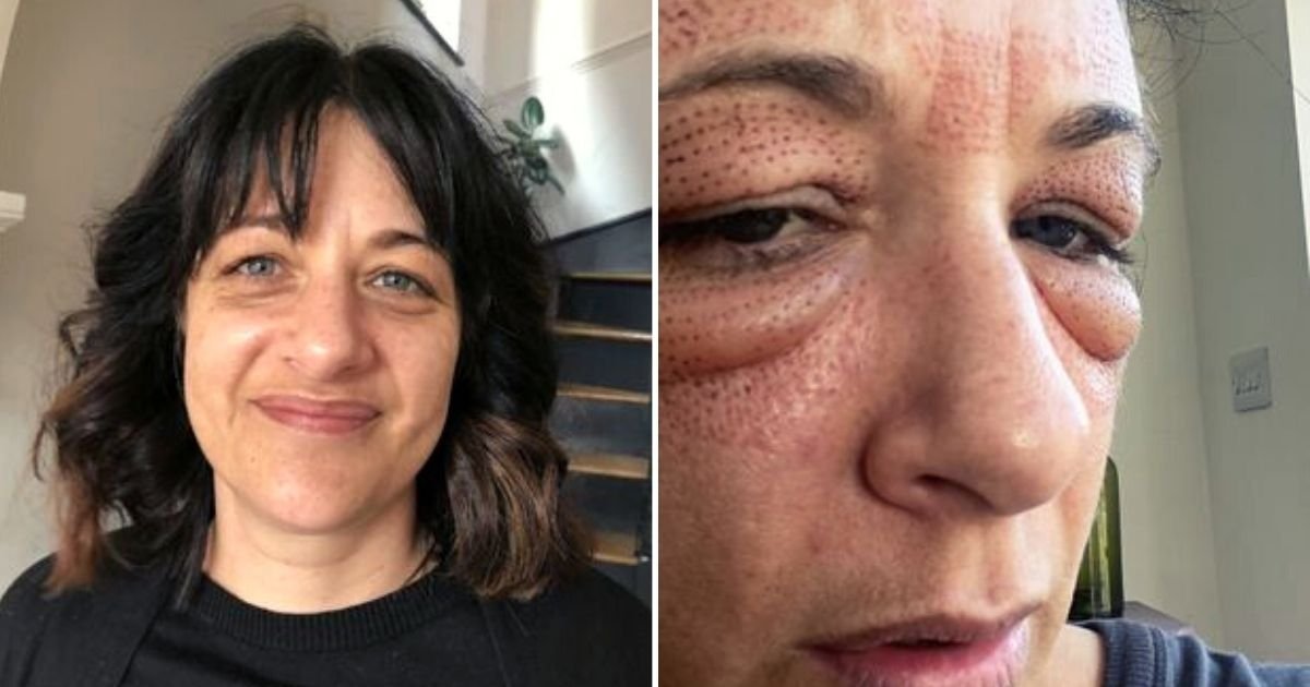 mariana5.jpg?resize=1200,630 - 40-Year-Old Mother Left Unrecognizable Even To Her Own Children After Strong Reaction To Eye Treatment