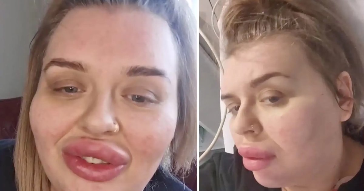 q4.png?resize=1200,630 - Mother Left With Lop-Sided Lips That Resembled A 'Baboon's Bum' After Filler Procedure Goes Horribly Wrong