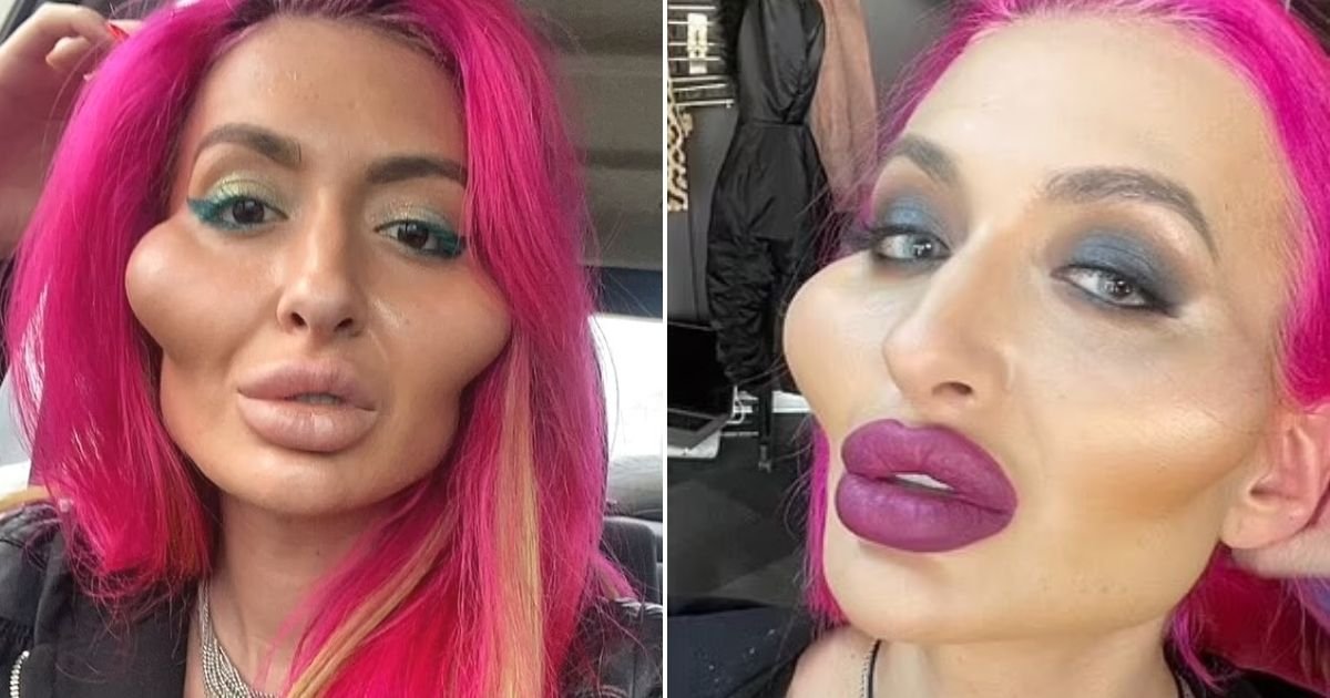 untitled design 43 1.jpg?resize=412,275 - Woman With 'World's Biggest Cheeks' Undergoes ANOTHER Procedure To Make Them Even BIGGER