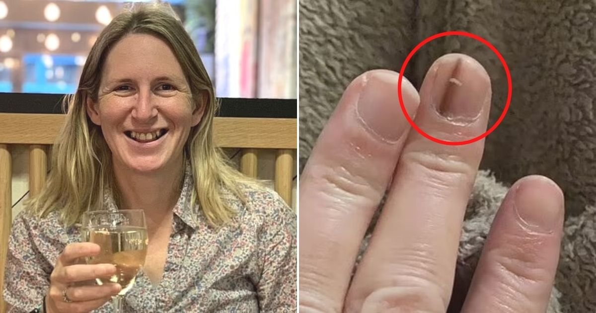 untitled design 52 1.jpg?resize=412,275 - Mother Forced To Amputate Her Finger After She Spotted A Brown Line On Her Nail