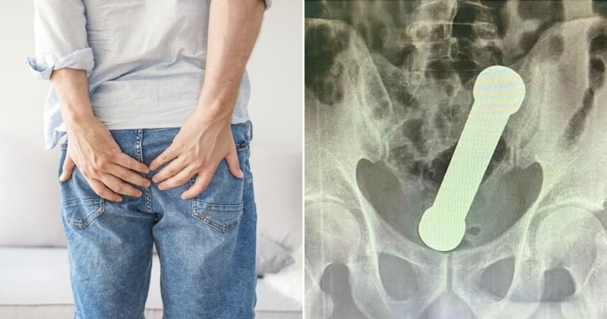 untitled design 72.jpg?fit=1024%2C538&ssl=1&strip=all - Man Rushed To The ER After A Giant DUMBBELL Got Stuck In His Rectum