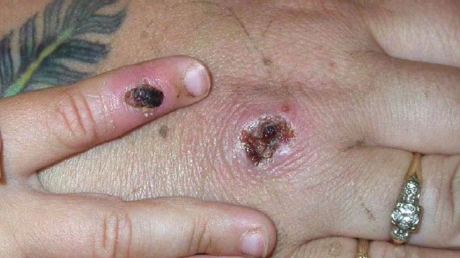 원숭이두창 환자의 손 / 사진=미국 질병통제예방센터(CDC)