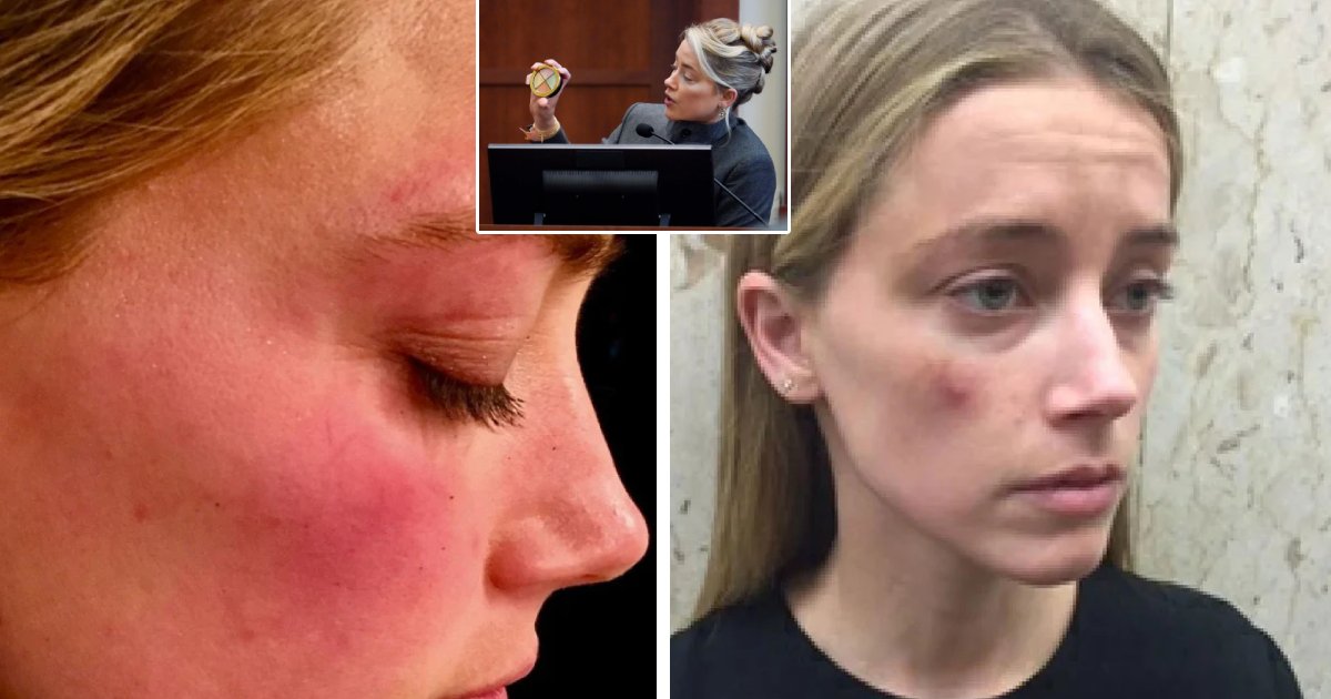 d5.png?resize=412,232 - BREAKING: Amber Heard Releases Startling & Troubled Images Of Abuse Inflicted By Johnny Depp
