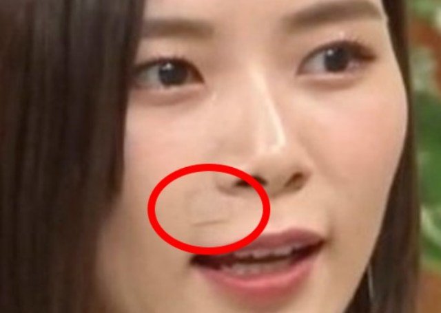 画像】朝日奈央 ほくろ除去した！テープ（絆創膏）は手術後か？ ｜ black-newstv