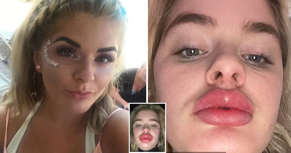 d82.jpg?resize=412,275 - "I Looked Like A Blow-Up Doll"- Mother Who Suffered From A Terrible 'Botched Lip Filler' Incident Says Doctors Laughed At Her