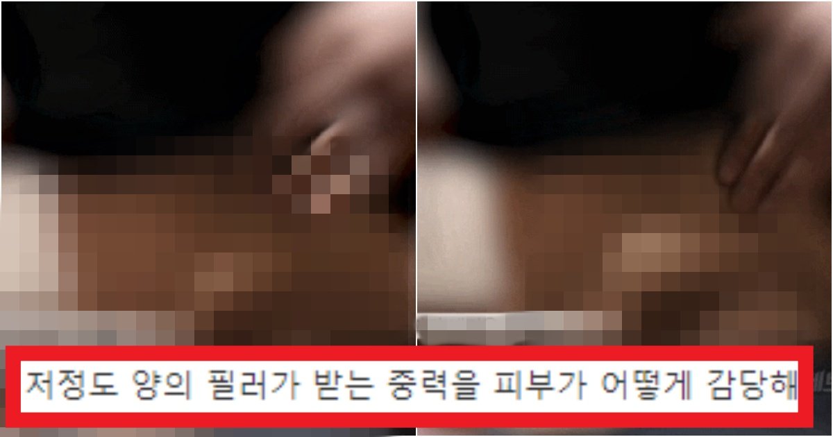 collage 173.jpg?resize=412,275 - '보형물보다 안전해요^^~' 사이즈 키우는 필러를 맞았더니 갈비뼈에 생긴 일(+실제 사진)