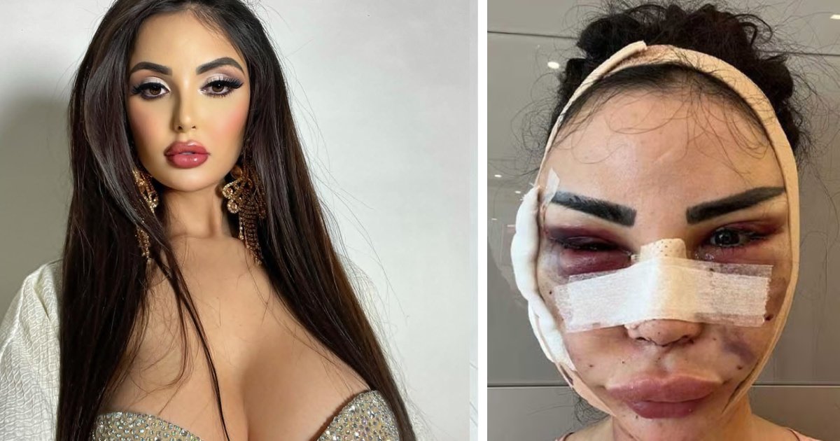 d8 1.png?fit=1024%2C538&ssl=1&strip=all - Model Who Spent $600,000 To Look Like Kim Kardashian Is Forced To Spend Double The Money For Her Reversal