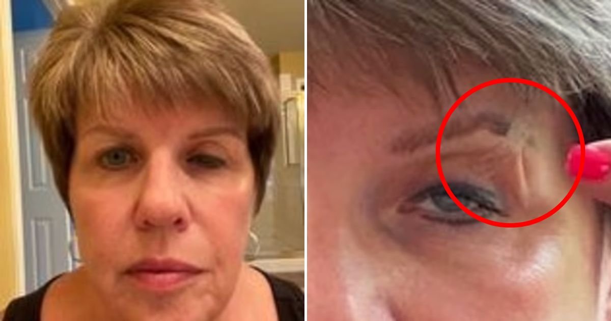 eye.jpg?resize=1200,630 - 55-Year-Old Woman Was Left BLIND And Had To TAPE Her Drooping Eyelid Open To See After Visiting A Local Spa To Get Botox