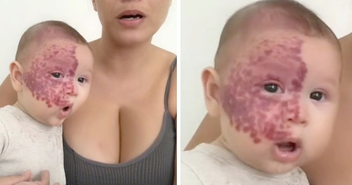t2 4.png?resize=1200,630 - "I Did What's Best For Him!"- Mother Blasted As A MONSTER For Removing Her Baby's Birthmark With Laser