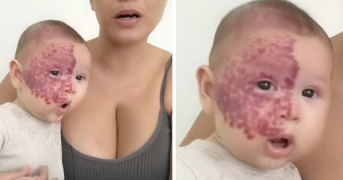 t2 4.png?resize=412,275 - "I Did What's Best For Him!"- Mother Blasted As A MONSTER For Removing Her Baby's Birthmark With Laser