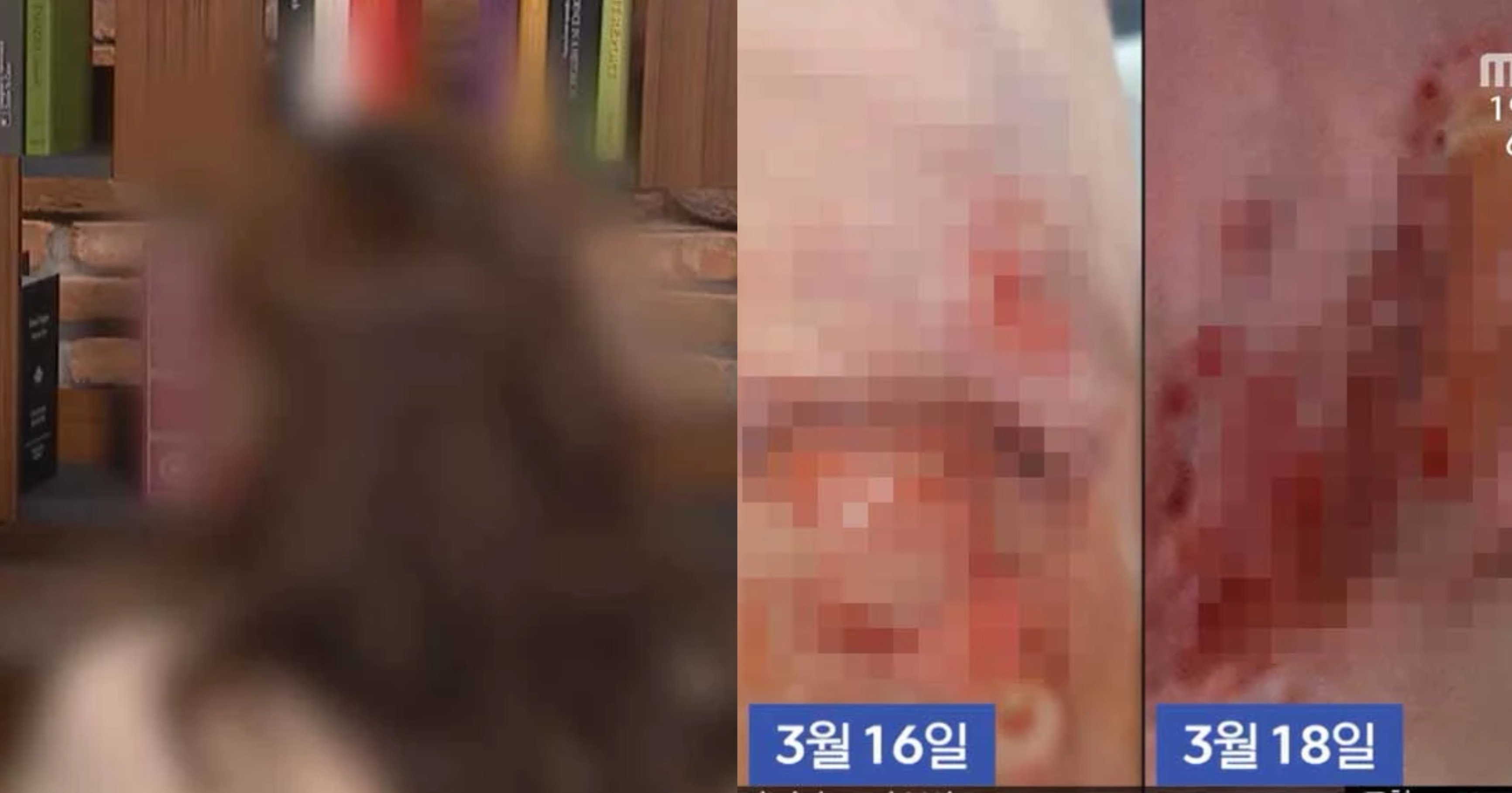 6e1d68e8 e9b9 4bf0 9359 fd38d2026aac 1.jpeg?fit=1024%2C537&ssl=1&strip=all - "지흡하고 3일만에 피부가 썩었어요".. 강남에서 지방흡입수술 받은 30대 여성의 '충격적인' 몸 상태(+사진)