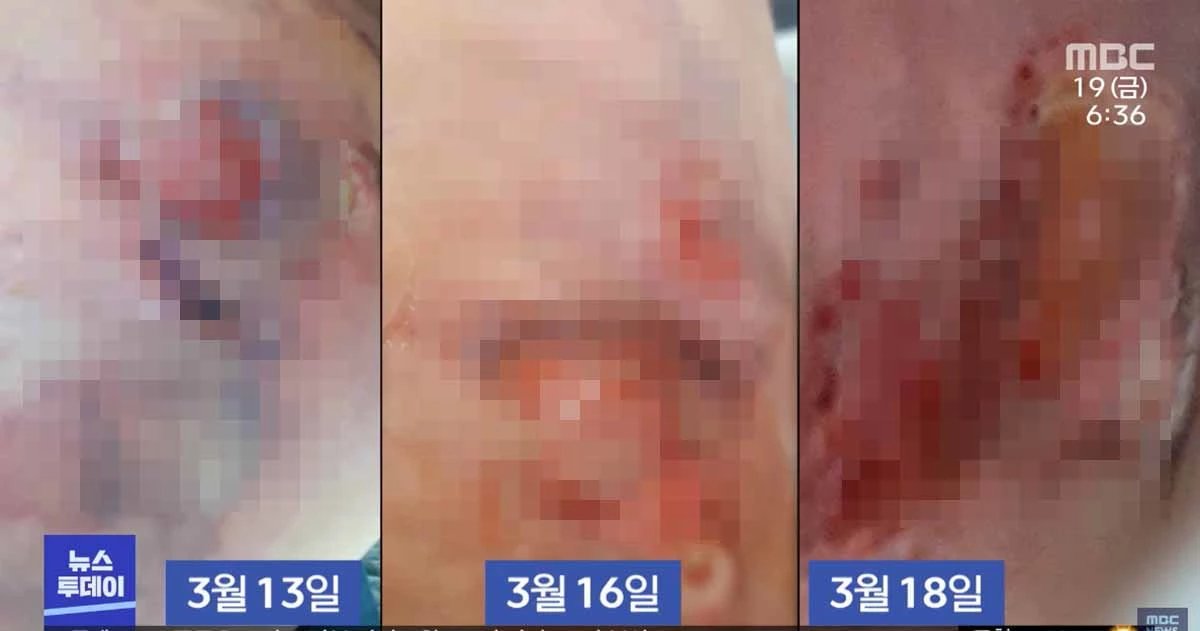 지방흡입수술을 받은 A씨의 피부 상태 / MBC 뉴스 영상 캡처