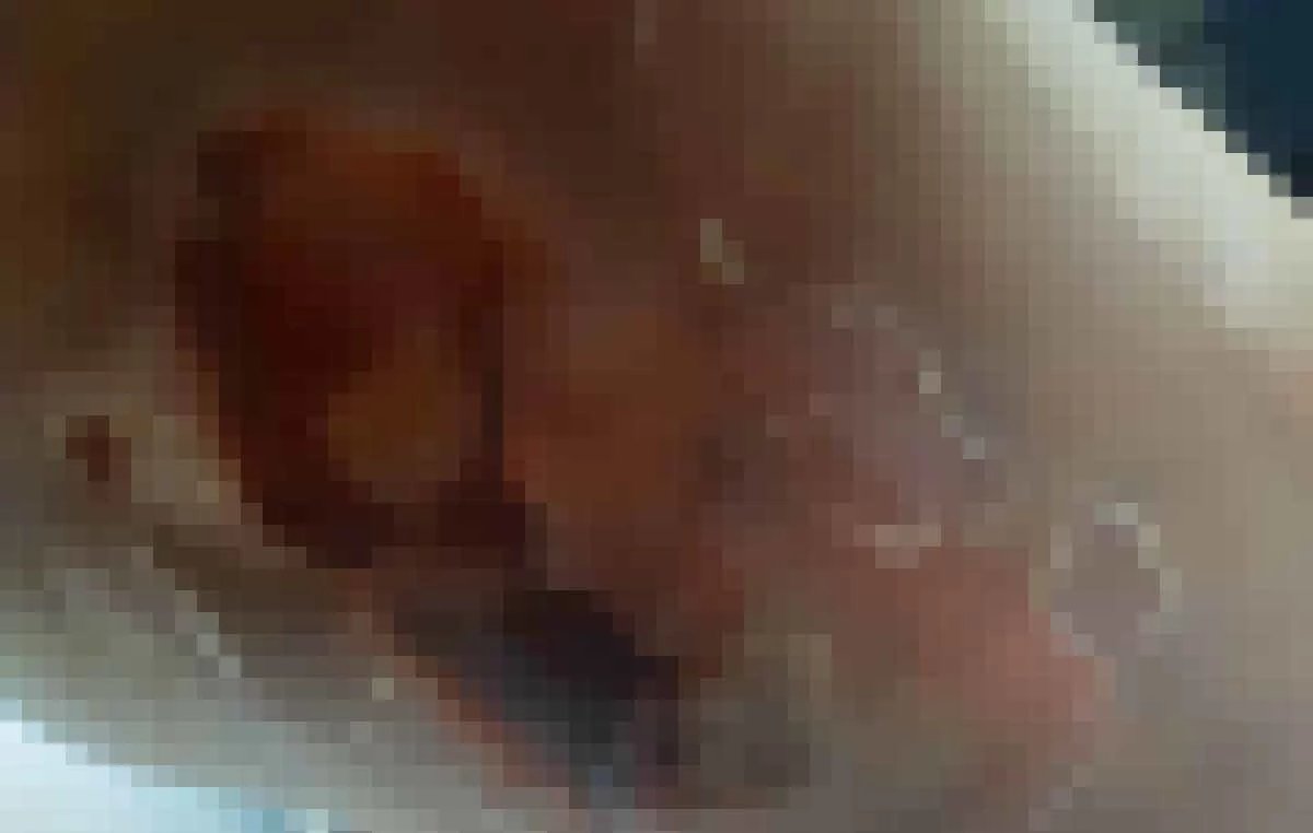 지방흡입수술을 받은 A씨의 피부 상태 / MBC 뉴스 영상 캡처