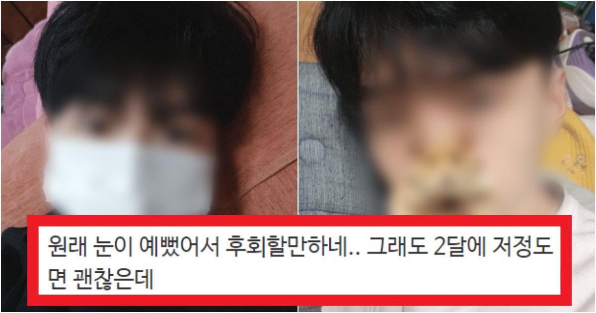 collage 106.png?resize=412,275 - '남자는 쌍수하지마요 후회합니다..' 주변 만류에도 쌍수를 강행해버린 남자의 역대급 후기(+전후 사진)