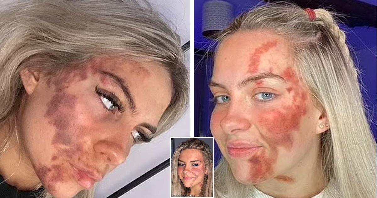 d45.jpg?resize=1200,630 - 18-Year-Old Student Leaves Doctors STUNNED With Her 'Painful' Skin Condition That Allows Her Face To Bruise From Within