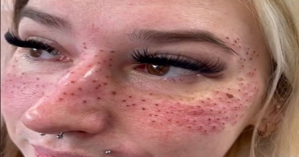 t10 2 2.png?resize=1200,630 - EXCLUSIVE: Woman Travels HUNDREDS Of Miles To Have Her Face 'Tattooed' With Freckles