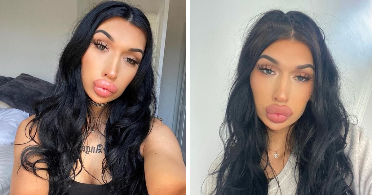 t5 11.png?resize=412,275 - "I'm OBSESSED With Lip Fillers & When I've Got A Sugar Daddy Paying For Them, Why Should I Worry?"