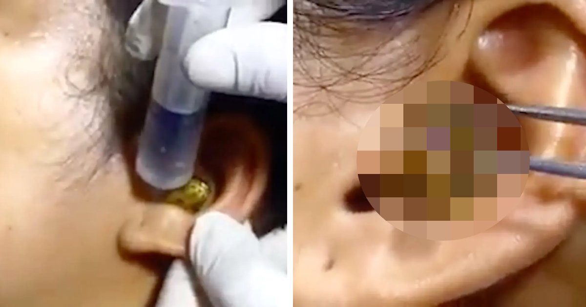t7 4 1.png?resize=1200,630 - EXCLUSIVE: Startling Footage Shows Surgeon Extract LIVE SNAKE From Patient's Ear