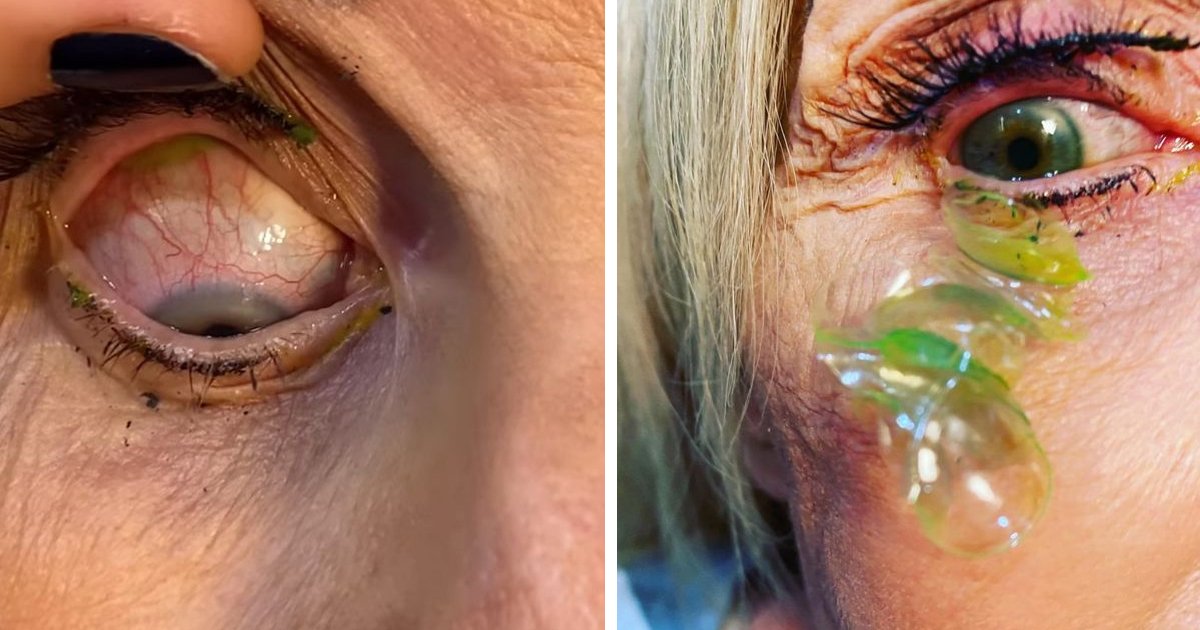 d66.jpg?resize=412,275 - BREAKING: Woman Has '23 Contact Lenses' Removed From Her Eye After TWO Years