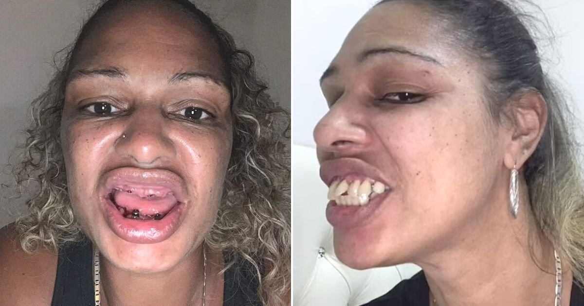 untitled design 28.jpg?resize=412,275 - Woman Who Was Bullied Because Of Her 'Horse Teeth' Reveals Her New Smile After Decades Of 'Embarrassing' Experiences