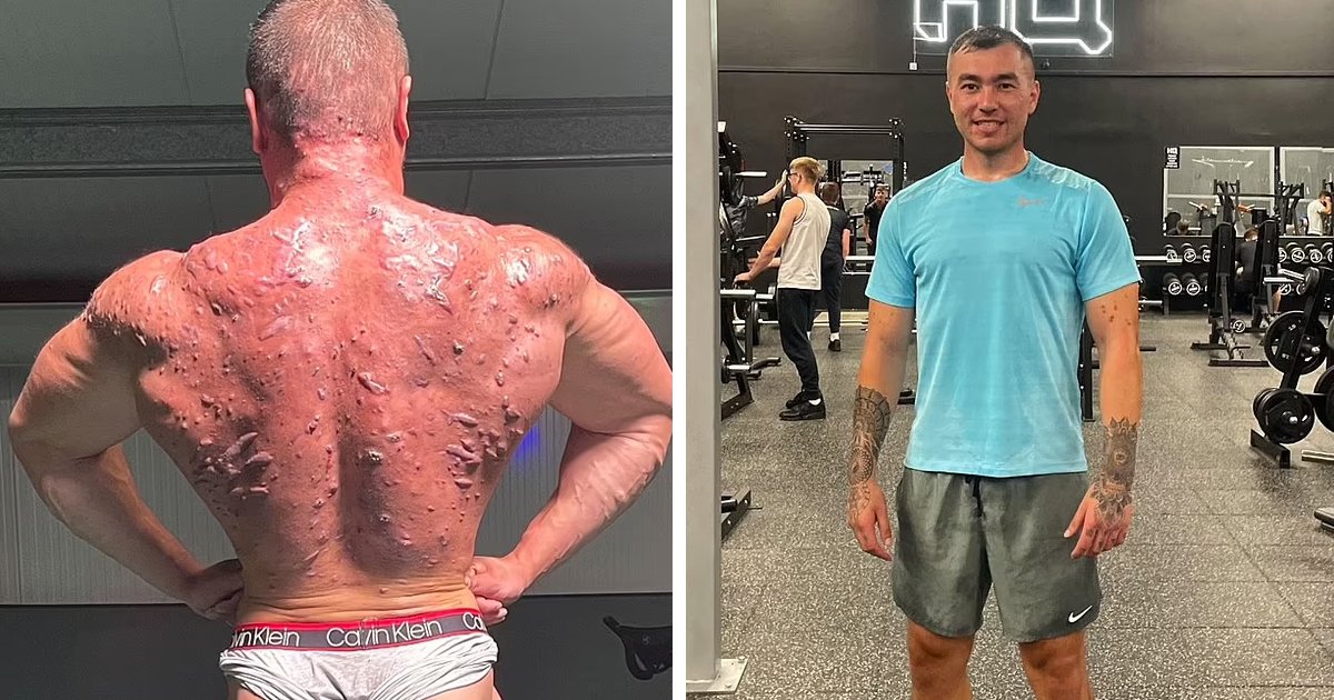 d125.jpg?resize=412,275 - JUST IN: Bodybuilder Found Covered In Horrific Scars Due To Steroid Use