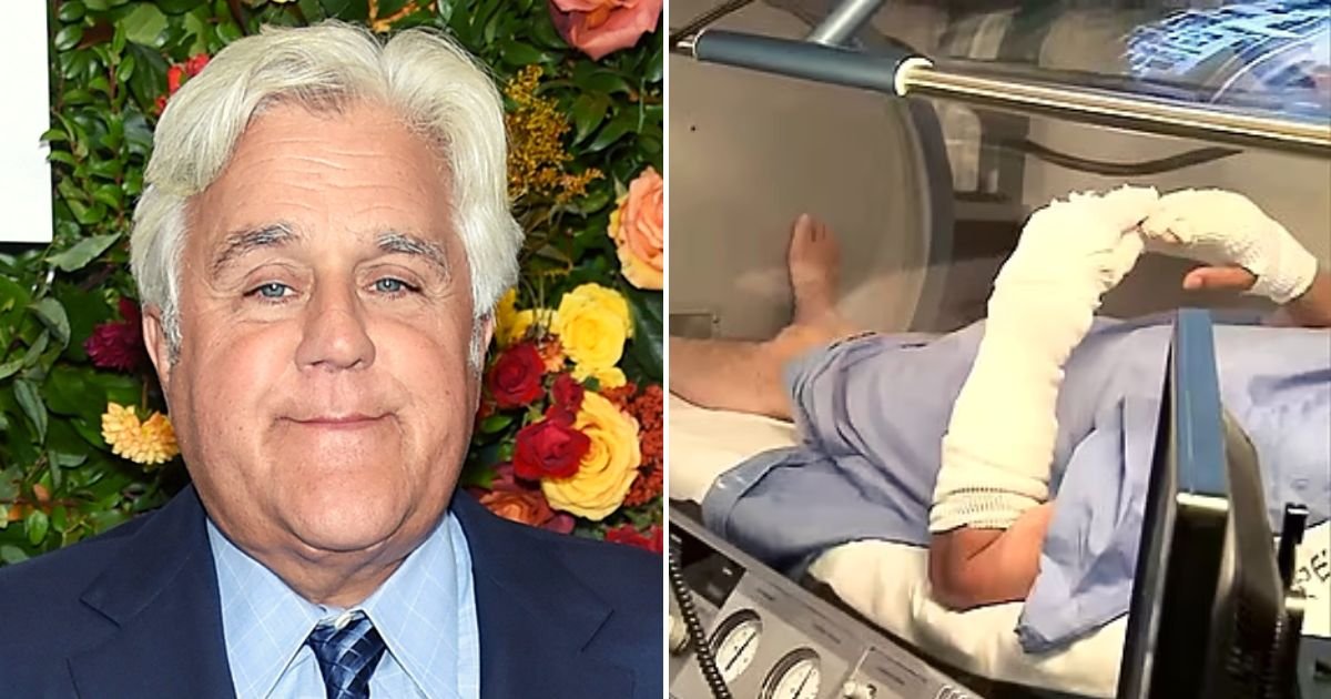 leno5.jpg?resize=412,275 - JUST IN: Comedian Jay Leno, 72, Is Seen With Bandaged Arms And Hands After Suffering From Serious Burns When His Car Burst Into Flames