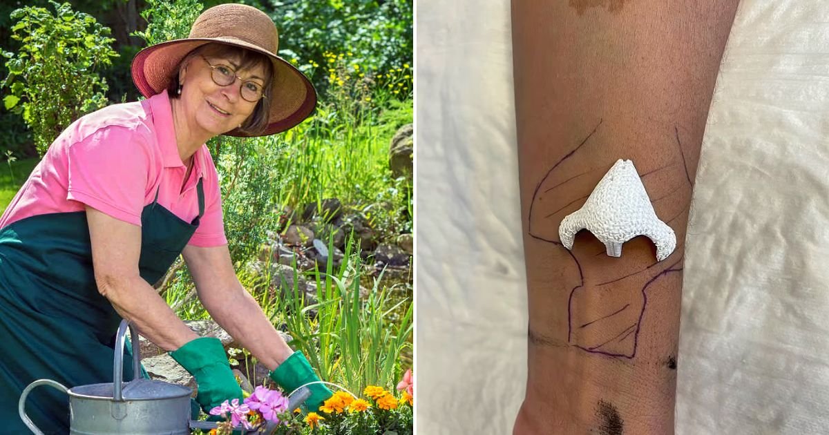 nose4.jpg?resize=412,275 - 50-Year-Old Woman Miraculously Grows A NOSE ON Her ARM And Finds Breathing Easier After She Lost The Old One 8 Years Ago