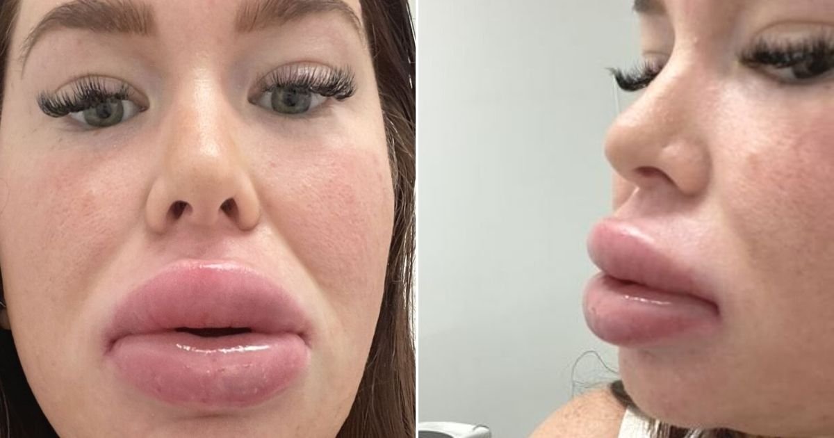 untitled design 13.jpg?resize=1200,630 - ‘My Lips Look Like SAUSAGES After Botched Procedure To Make Them Appear Fuller’