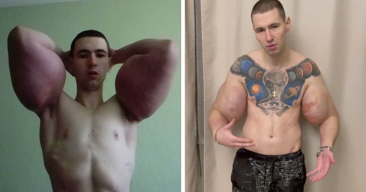 t9 4.png?resize=1200,630 - Bodybuilder Who Gained Viral Fame For Injecting Oil Inside His Arms Is Now Calling Himself 'Mr Olympia'