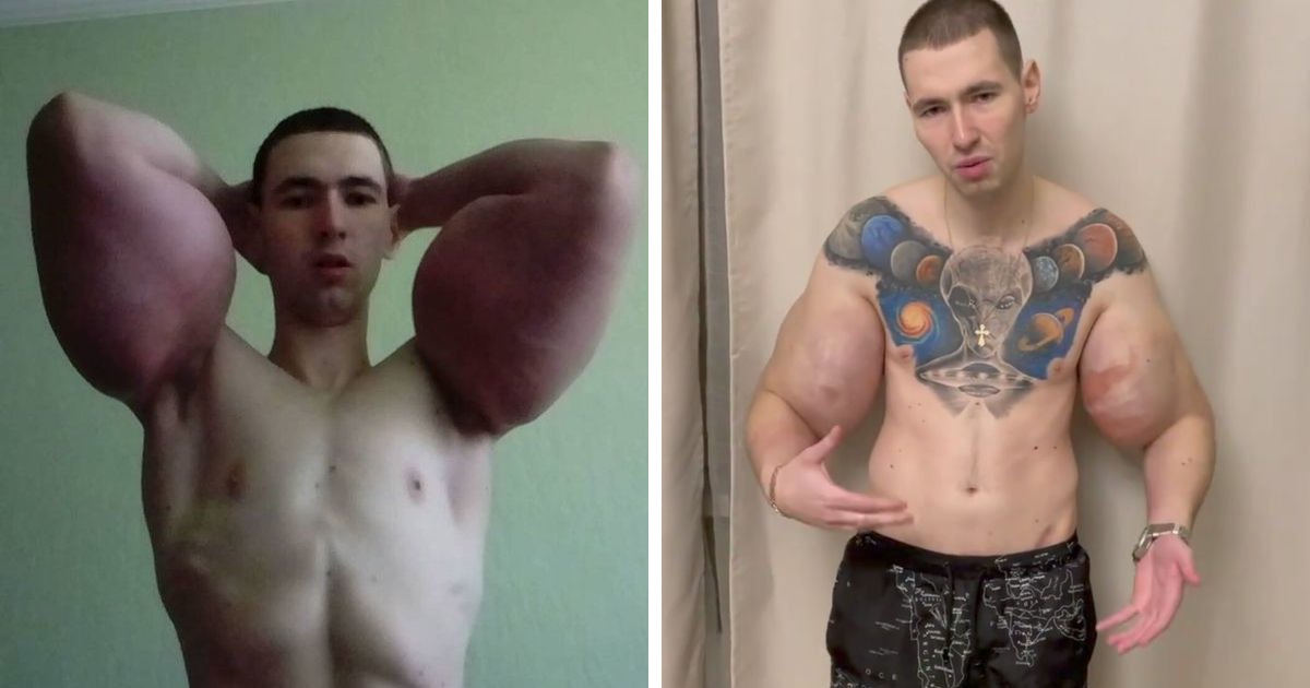 t9 4.png?resize=412,232 - Bodybuilder Who Gained Viral Fame For Injecting Oil Inside His Arms Is Now Calling Himself 'Mr Olympia'