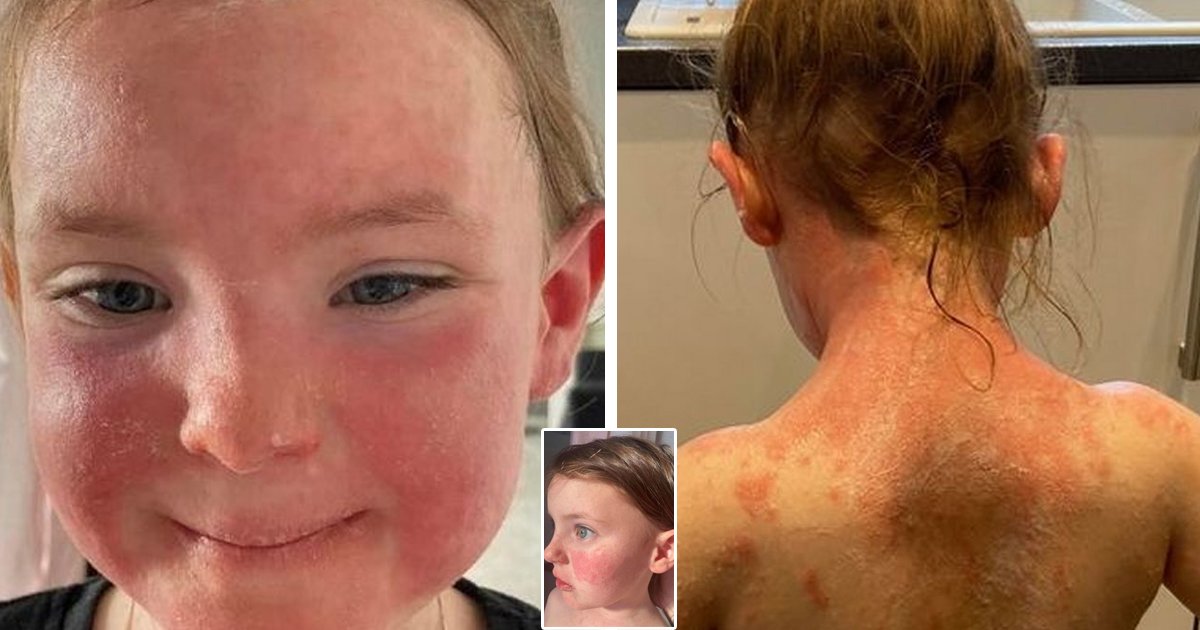 d8.jpg?resize=1200,630 - BREAKING: Worried Mom Alerts Other Parents About 'Sunburn Skin' Rash As Child Hit With Terrifying Strep A Infection Symptom