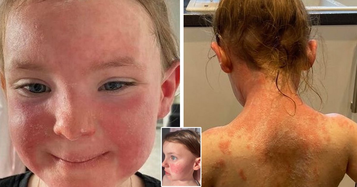 d8.jpg?resize=412,275 - BREAKING: Worried Mom Alerts Other Parents About 'Sunburn Skin' Rash As Child Hit With Terrifying Strep A Infection Symptom