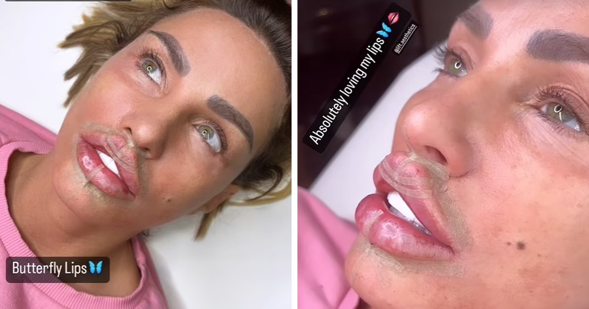 d42.jpg?resize=412,275 - EXCLUSIVE: Katie Price Reveals Her HUGE Pout After Getting Even More Filler Injected