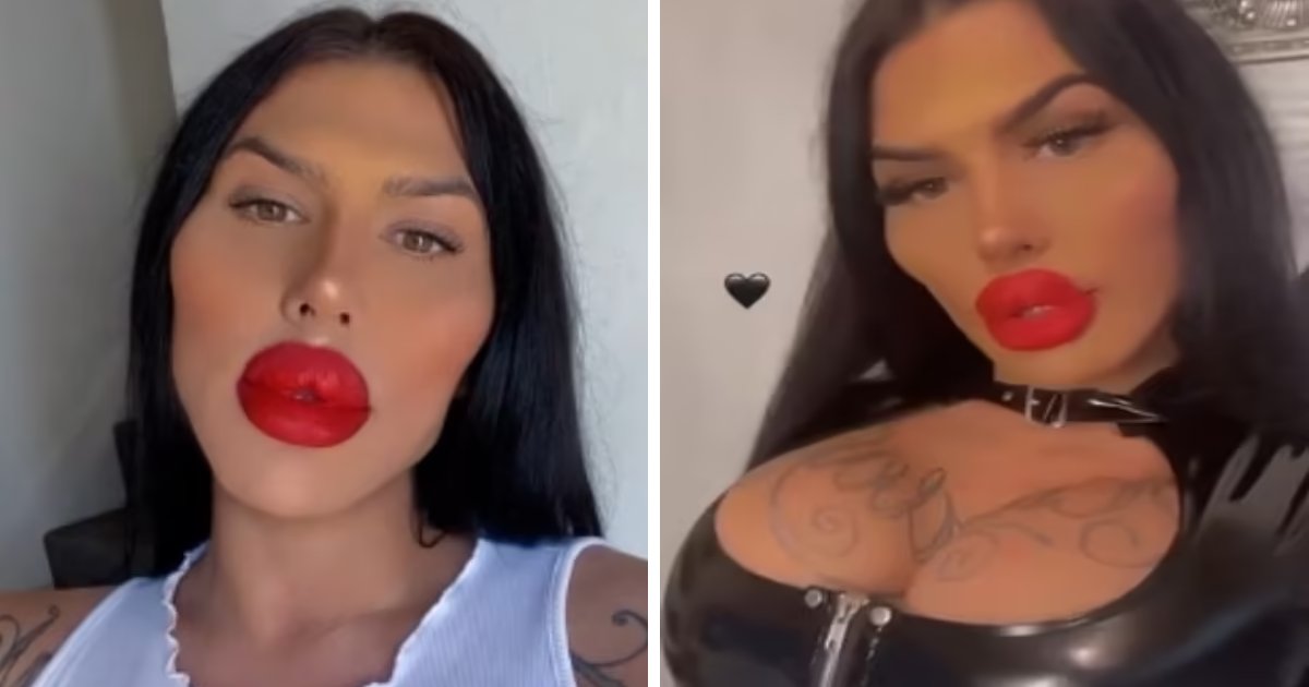 t2 8 1.png?fit=1024%2C538&ssl=1&strip=all - "I've Had ONE HUNDRED Filler Injections To Get The Lips Of My Dreams & I Won't Stop Anytime Soon!"