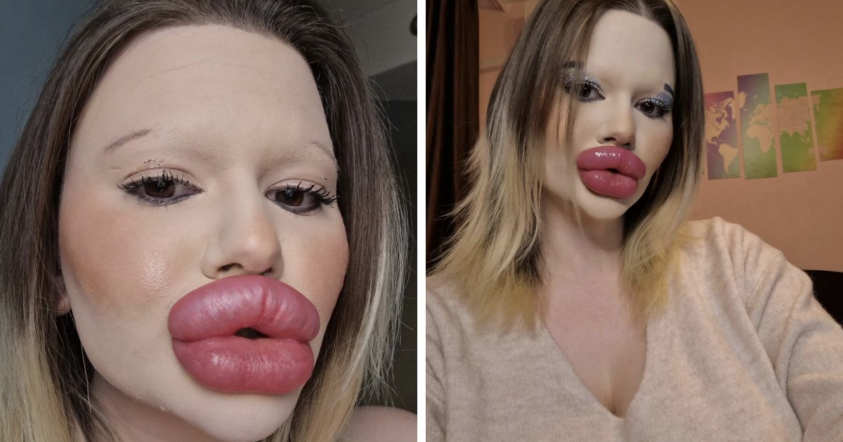t6 7 1.png?resize=1200,630 - EXCLUSIVE: Woman With World's 'Biggest Lips' Is Now Getting The World's 'Biggest Cheeks'
