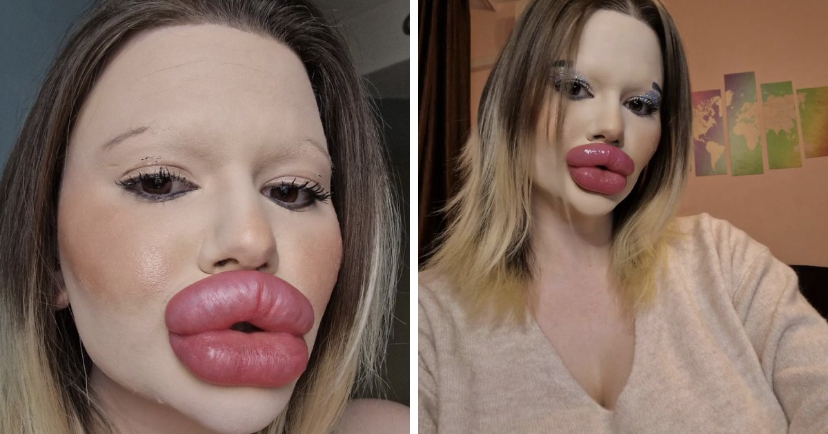 t6 7 1.png?resize=412,275 - EXCLUSIVE: Woman With World's 'Biggest Lips' Is Now Getting The World's 'Biggest Cheeks'