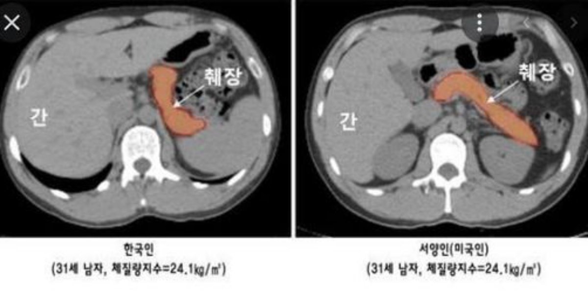 338284403 750353796800084 9175000853384265802 n.jpeg?resize=412,275 - 한국인이 서양인처럼 먹으면 ㅈ되는 이유;;;;.jpg