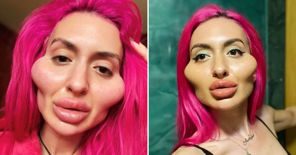 ana4.jpg?resize=1200,630 - Woman With The 'World's Biggest Cheeks' Leaves Fans ALARMED With Her LATEST Surgery And Many Fear She Has Taken Things Too Far